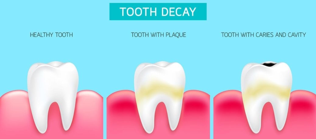 Teeth Genetics | Genetics and Teeth | Poor teeth genetics | Tooth Decay | Missing teeth | Gum Disease | Orthodontics | Orthodontist | Emilia Taneva | Bubbly Moments
