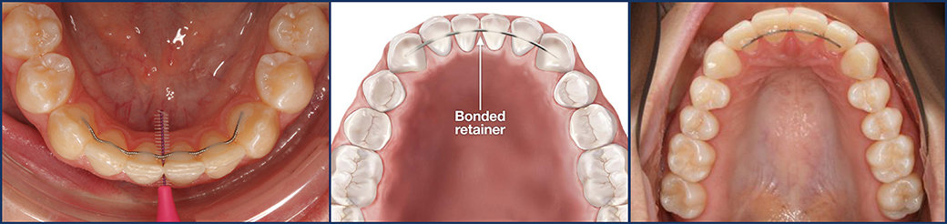 After Braces | Permanent Retainer | Types of Retainers | What is a Retainer | Purpose of Retainer | Hawley Retainer | Essix Retainer | Vivera Retainers | Fixed Retainer | Orthodontics | Orthodontist | Bubbly Moments