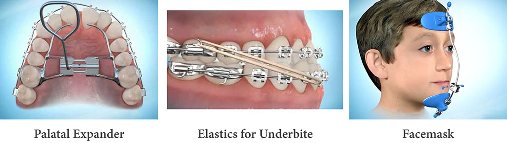 underbite, underbite correction, underbite braces, expander, rubber bands | Orthodontics | Chicago Orthodontist | Dr Emilia Taneva