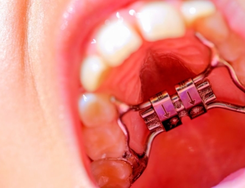 What’s a Palatal Expander and Who Should Get One?