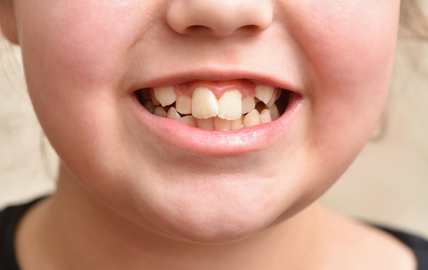 Crowded Teeth | Crooked Teeth | Misaligned Teeth | Overlapping Teeth | Bubbly Moments