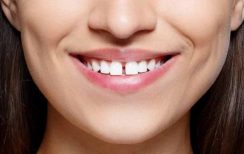 Braces vs Veneers | Gap in the Teeth | Dental Bonding | Bubbly Moments