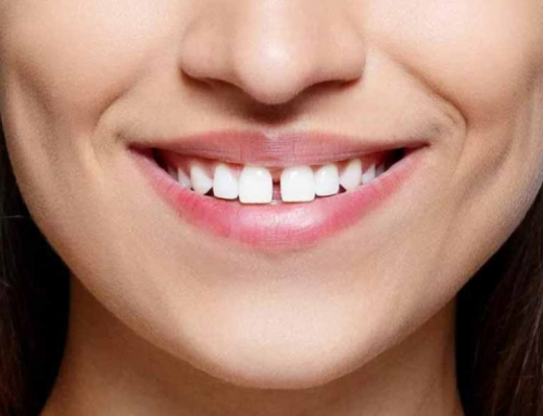 Should I Get Braces or Veneers to Close the Gap in My Teeth?